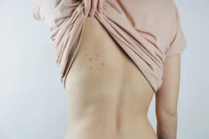 A female listing the back of her shirt, revealing a rash, the signs of bed bug issues.