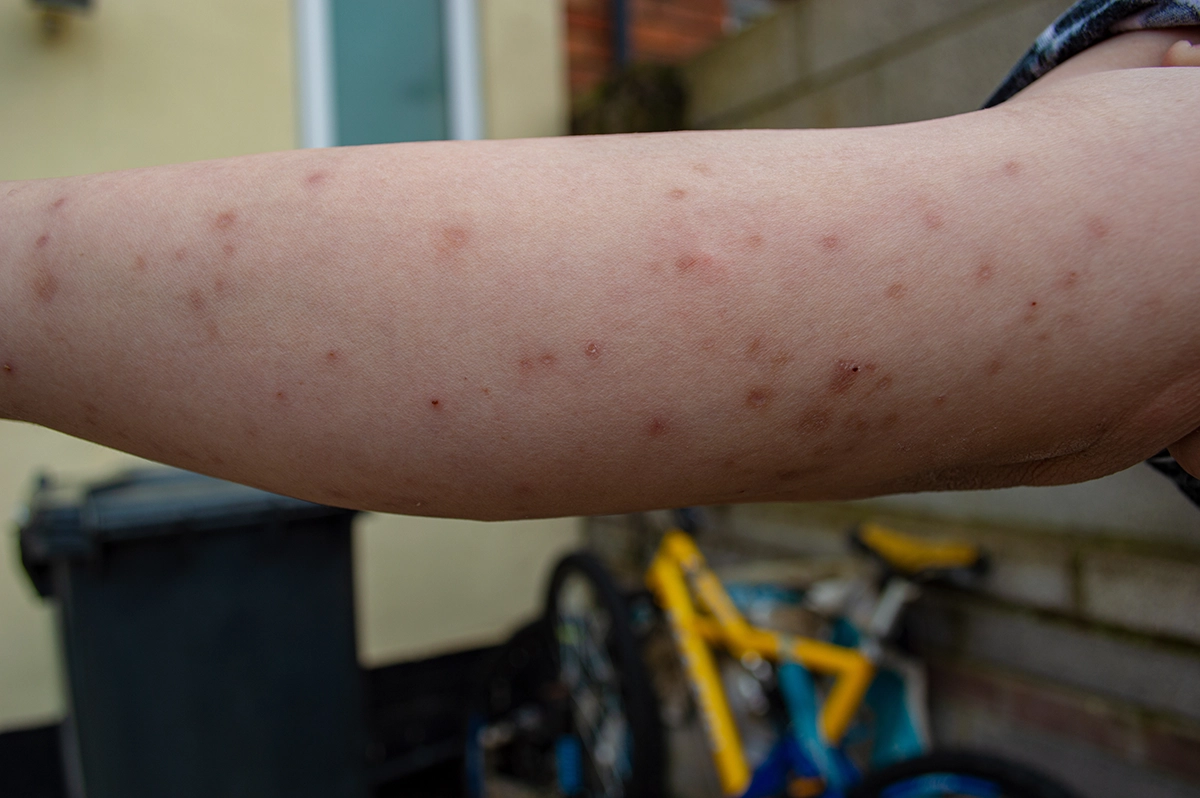 Arm covered in multiple bed bug bites, showing common bite patterns and skin reactions