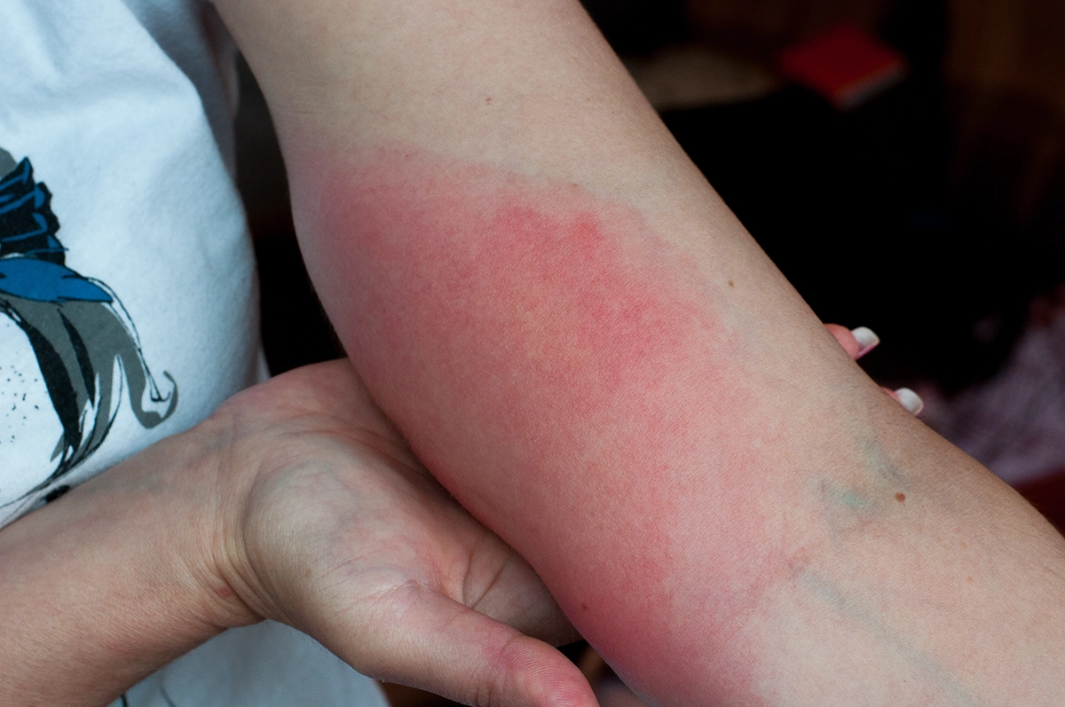 Red swollen skin reaction on forearm after a wasp sting